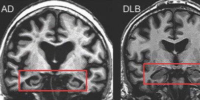 Arizona’s “Silver Tsunami”: Legislating Toward an Alzheimer’s Disease Plan